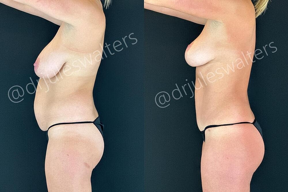 Fat Transfer Before & After