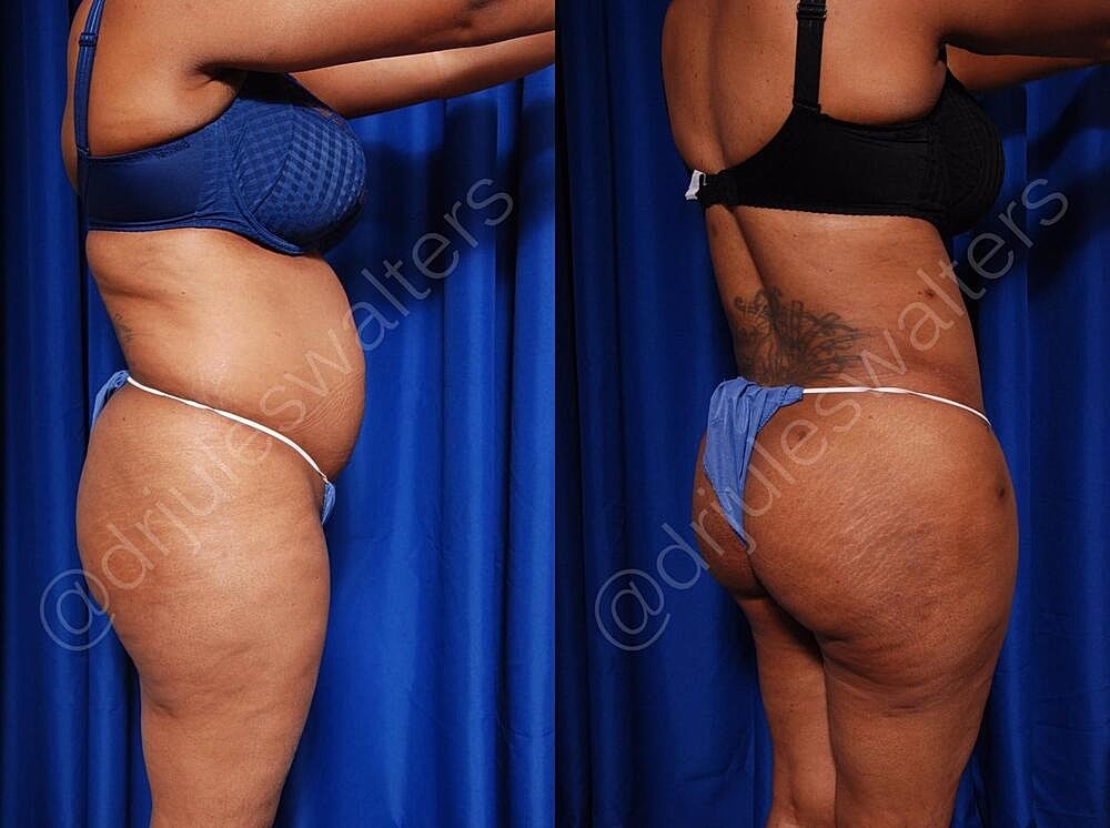 Fat Transfer Before & After