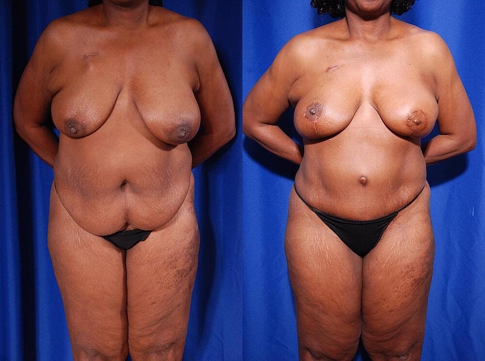 Fat Transfer Before & After