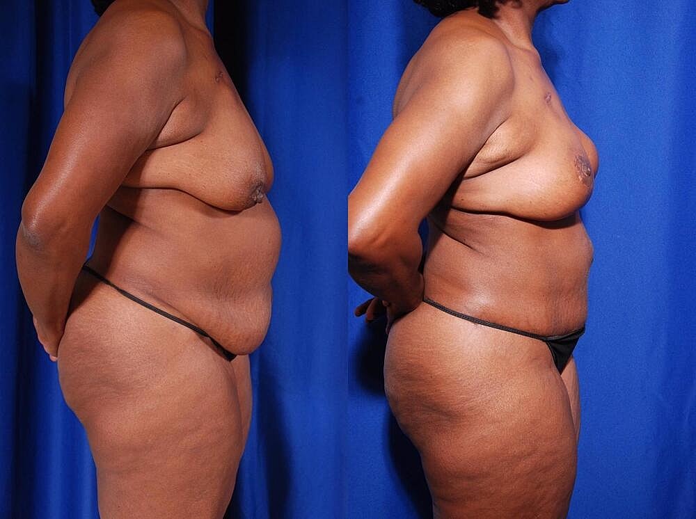 Fat Transfer Before & After