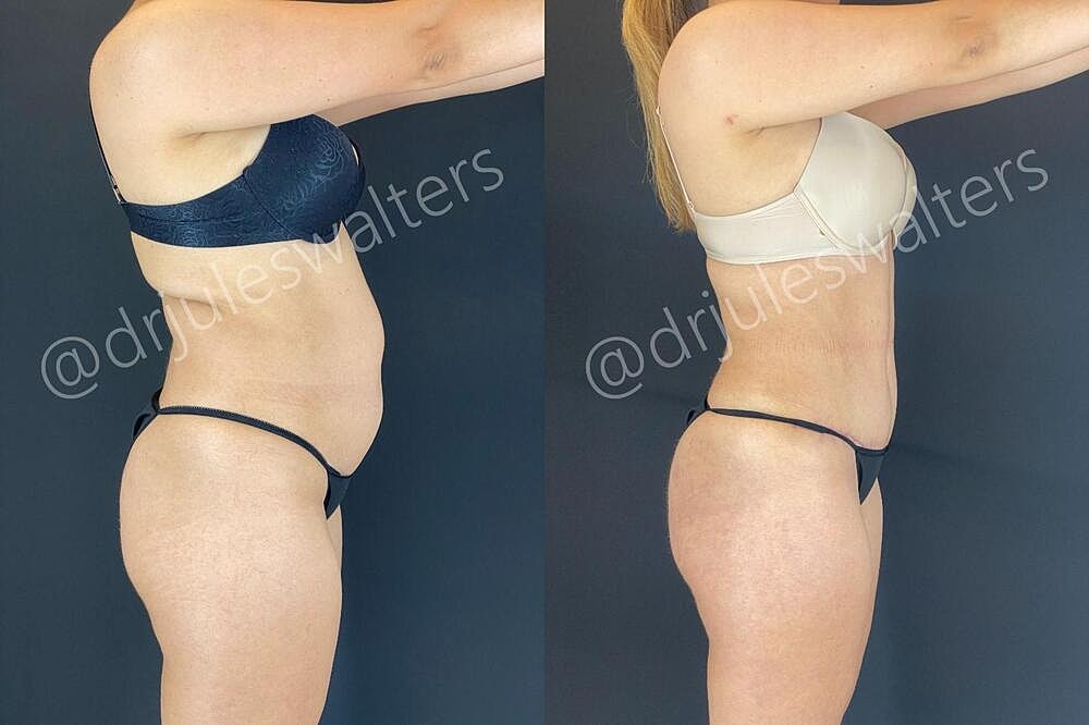 Fat Transfer Before & After