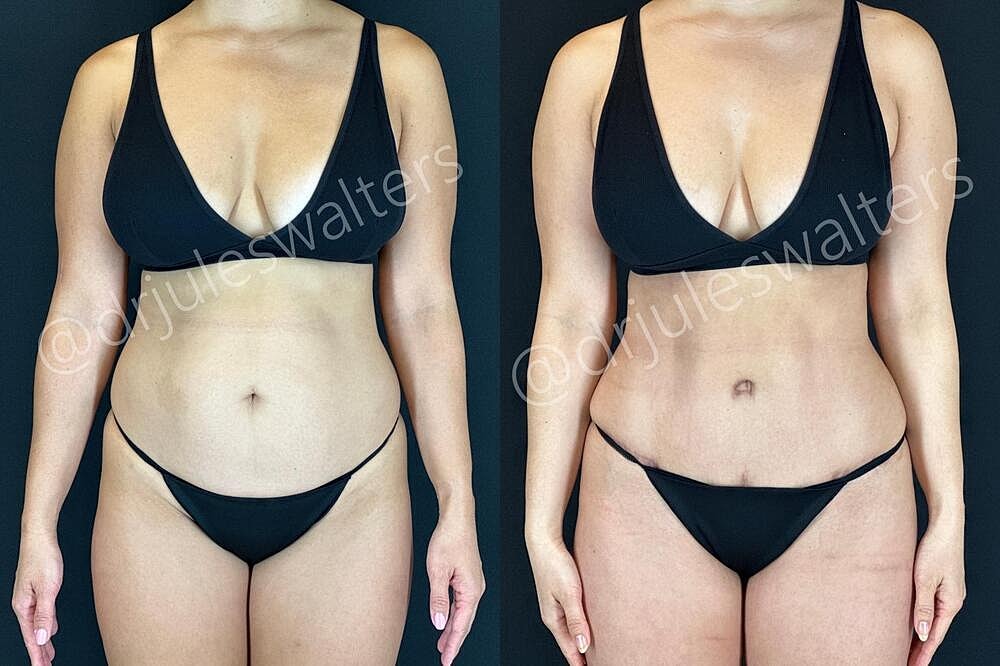 Fat Transfer Before & After