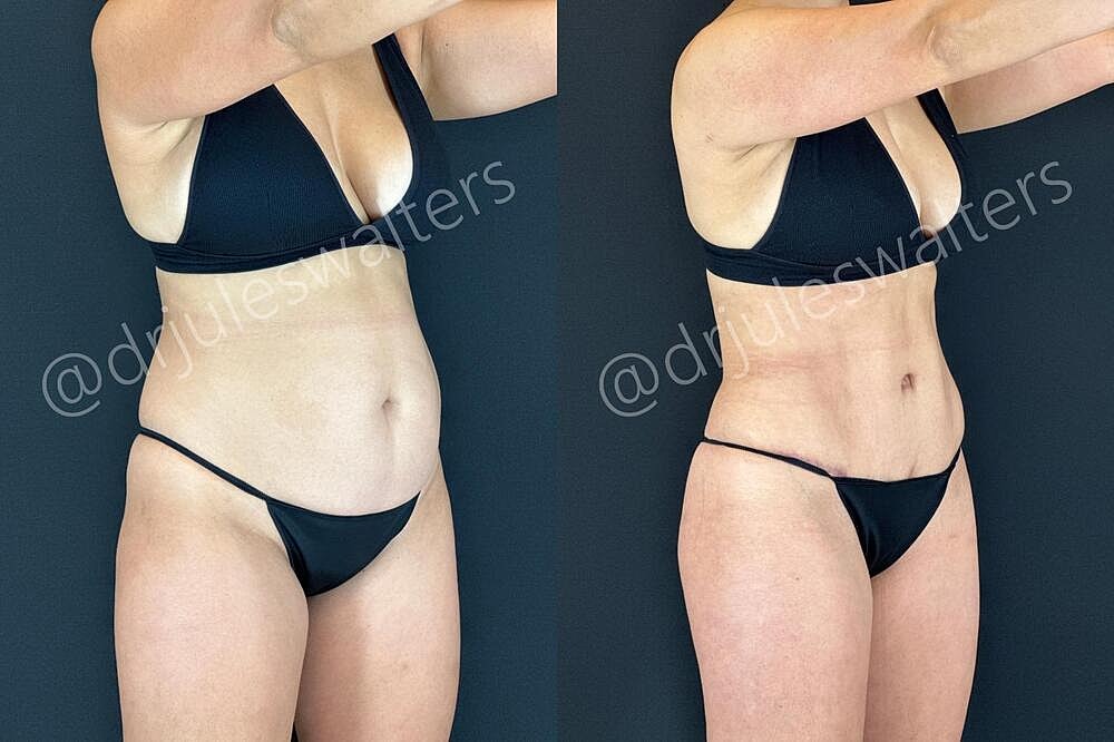 Fat Transfer Before & After