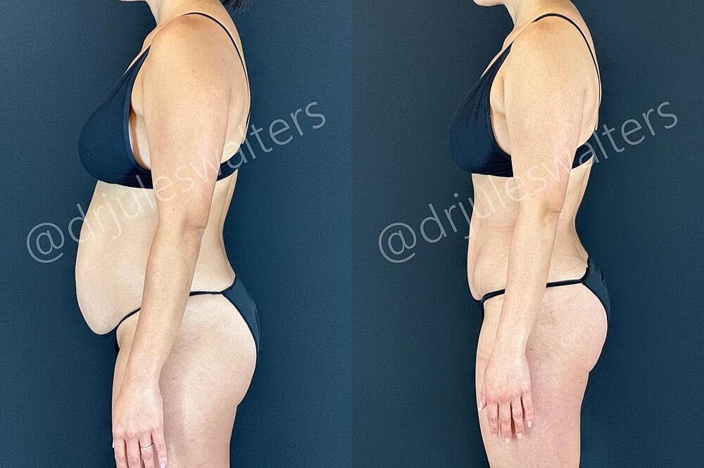 Fat Transfer Before & After