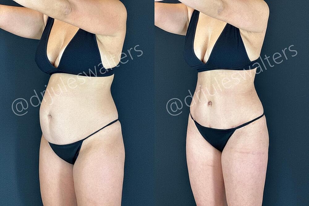 Fat Transfer Before & After