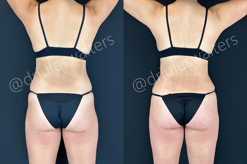 Fat Transfer Before & After