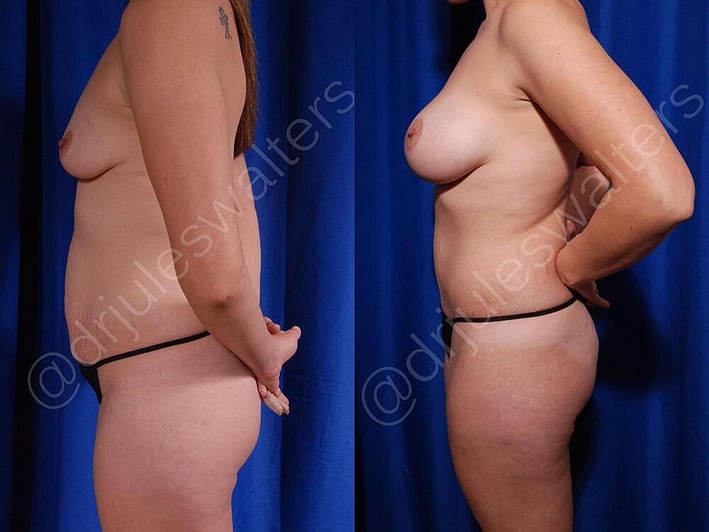 Fat Transfer Before & After