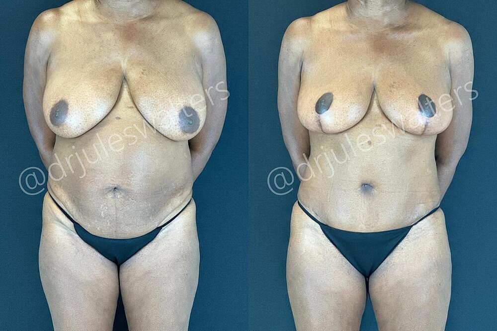 Fat Transfer Before & After
