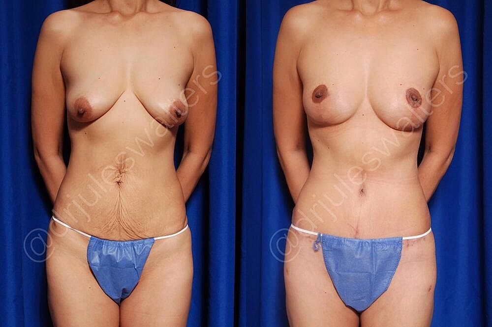 Fat Transfer Before & After