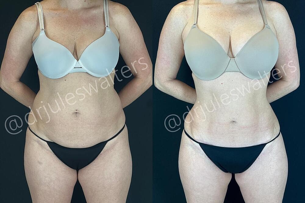Fat Transfer Before & After