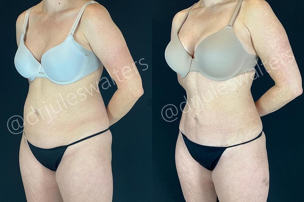 Fat Transfer Before & After