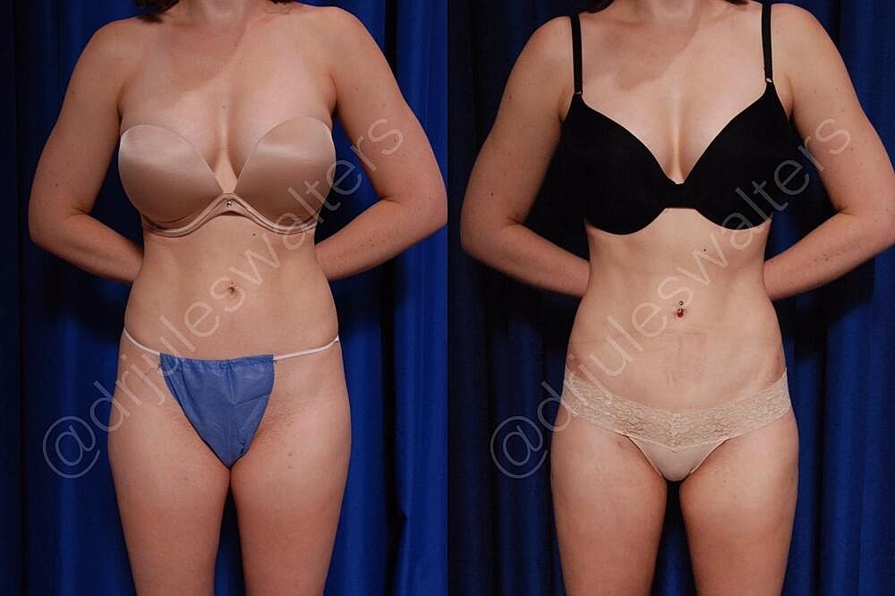 Fat Transfer Before & After