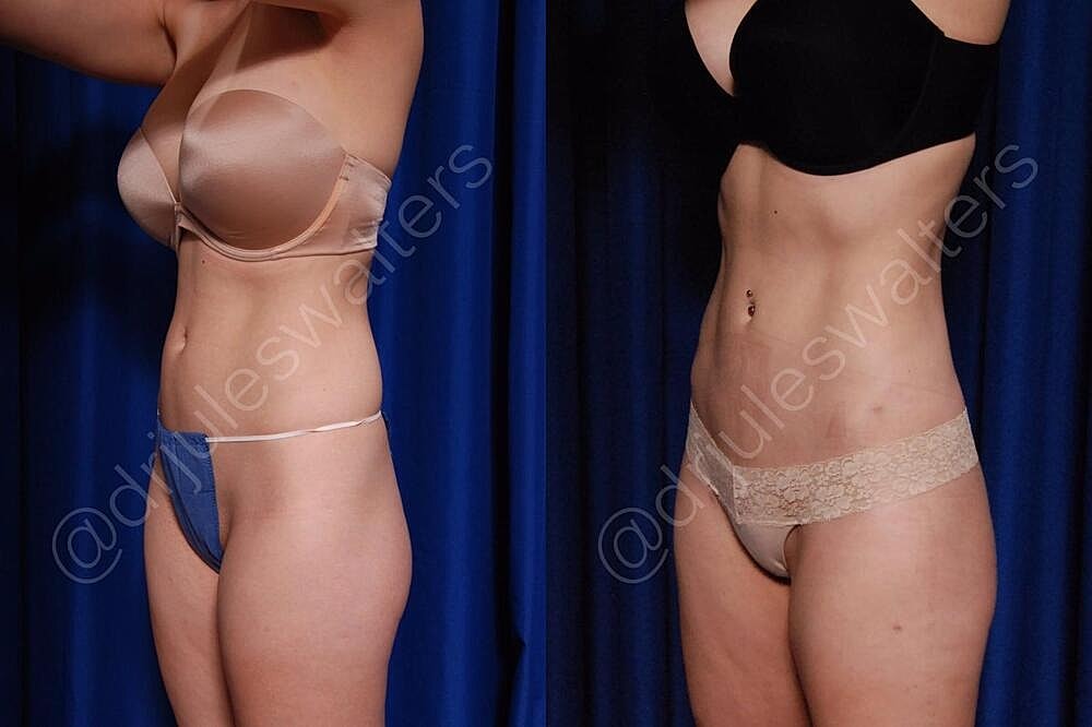 Fat Transfer Before & After