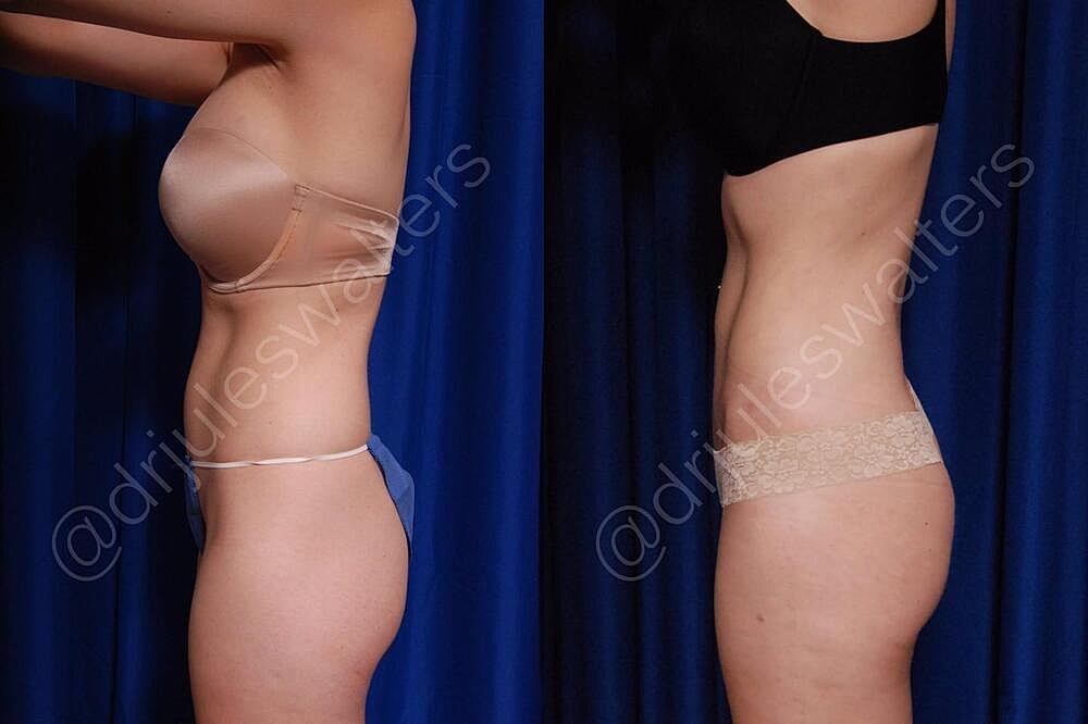 Fat Transfer Before & After