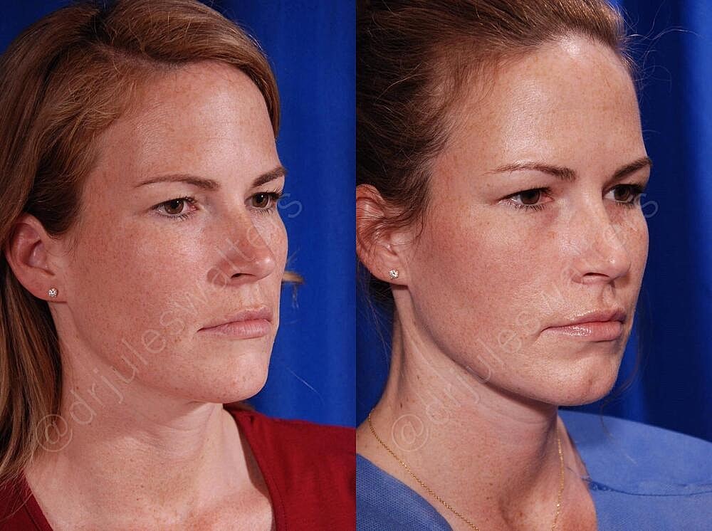 Fat Transfer Before & After