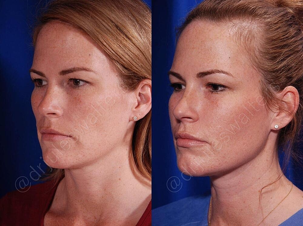 Fat Transfer Before & After