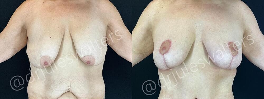 Fat Transfer Before & After