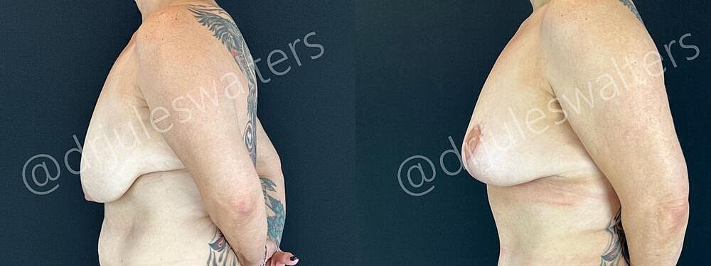 Fat Transfer Before & After