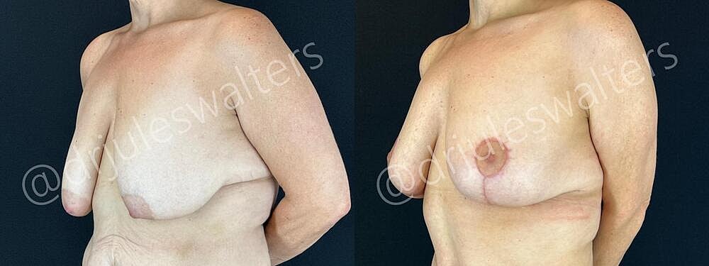 Fat Transfer Before & After
