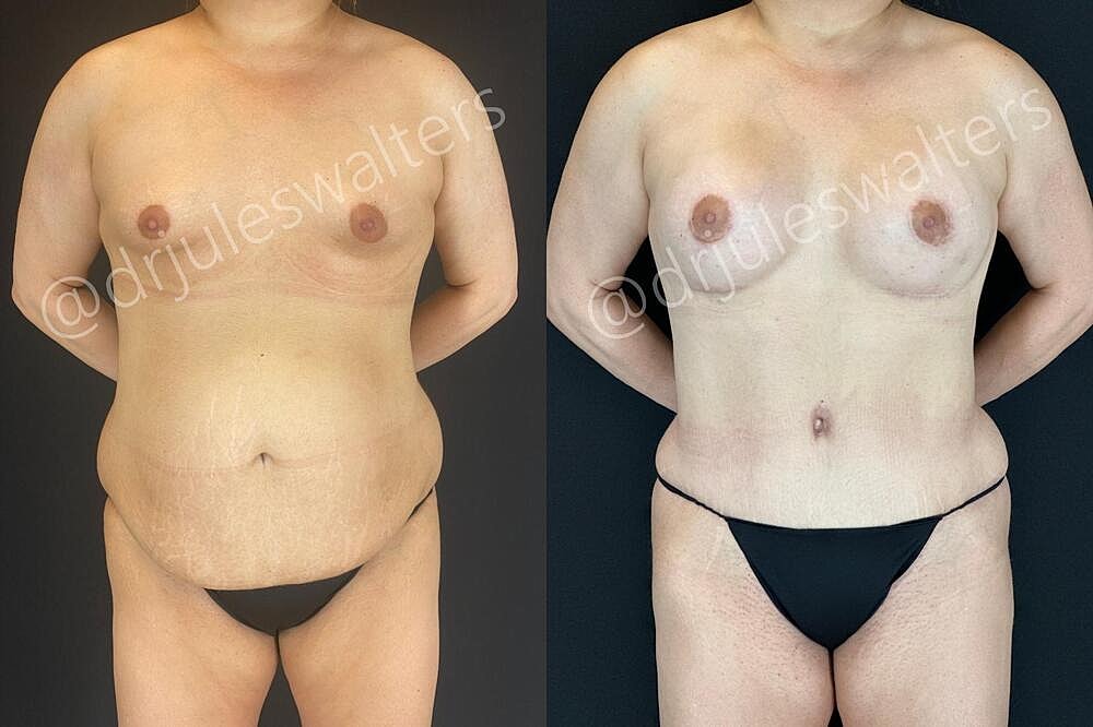 Fat Transfer Before & After