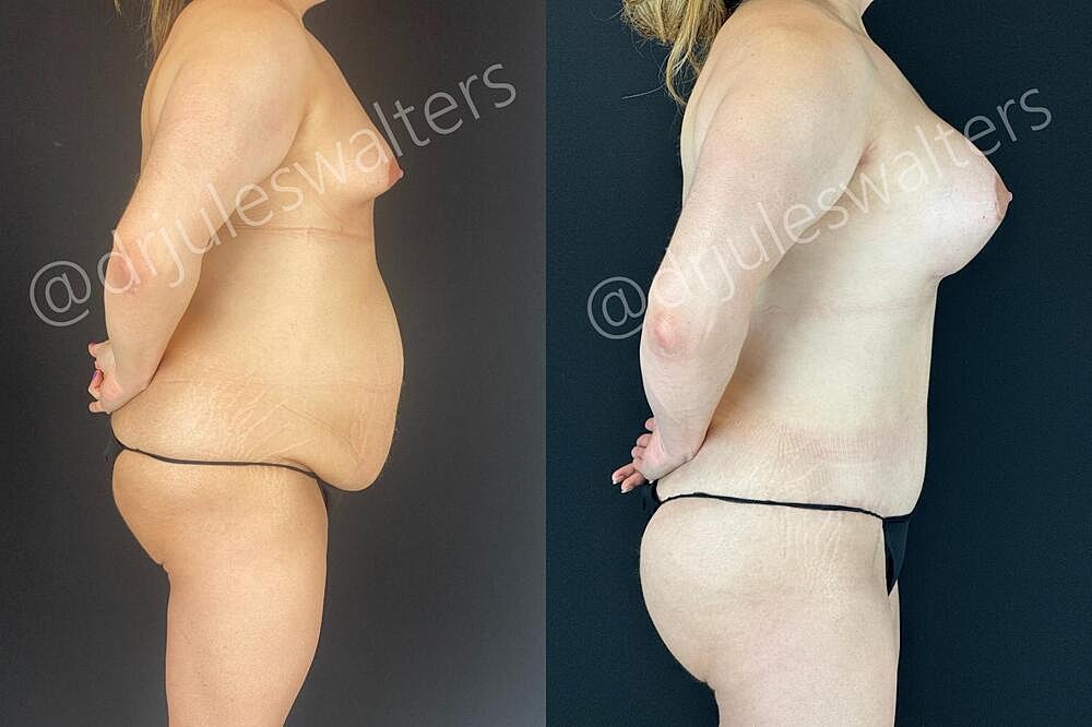 Fat Transfer Before & After