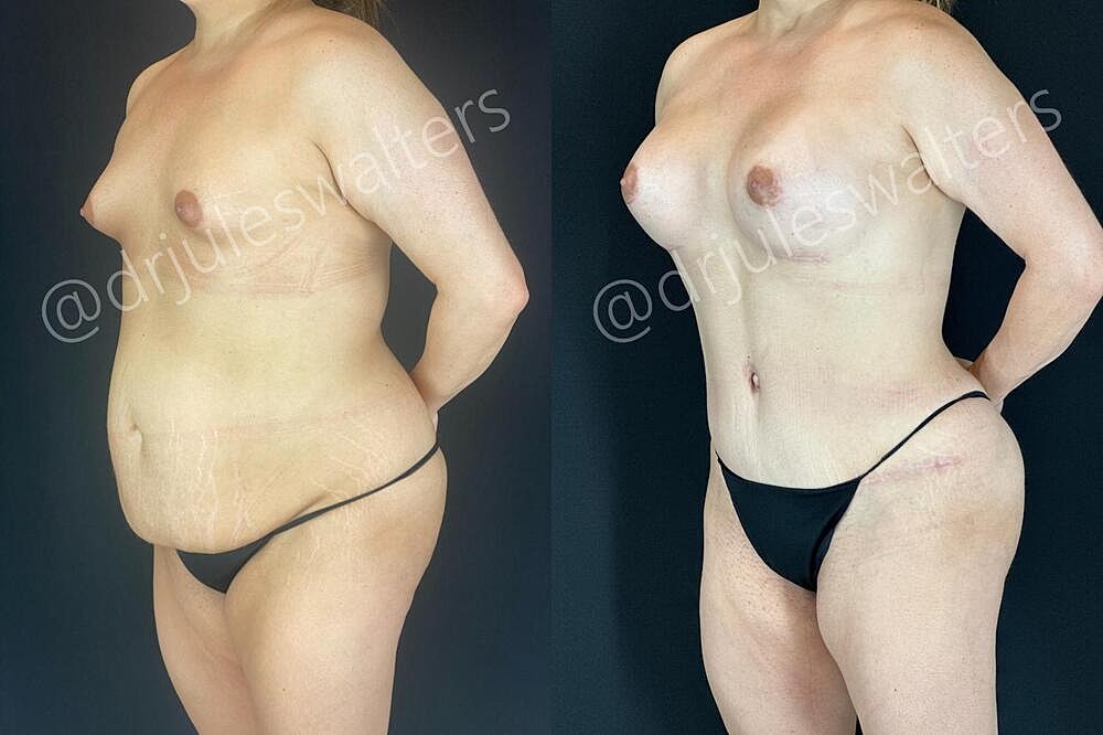Fat Transfer Before & After