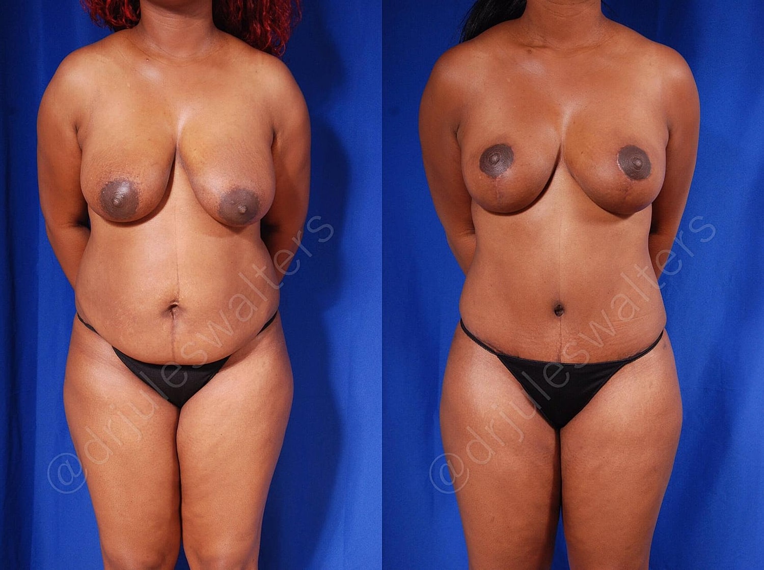 Tummy Tuck Before & After