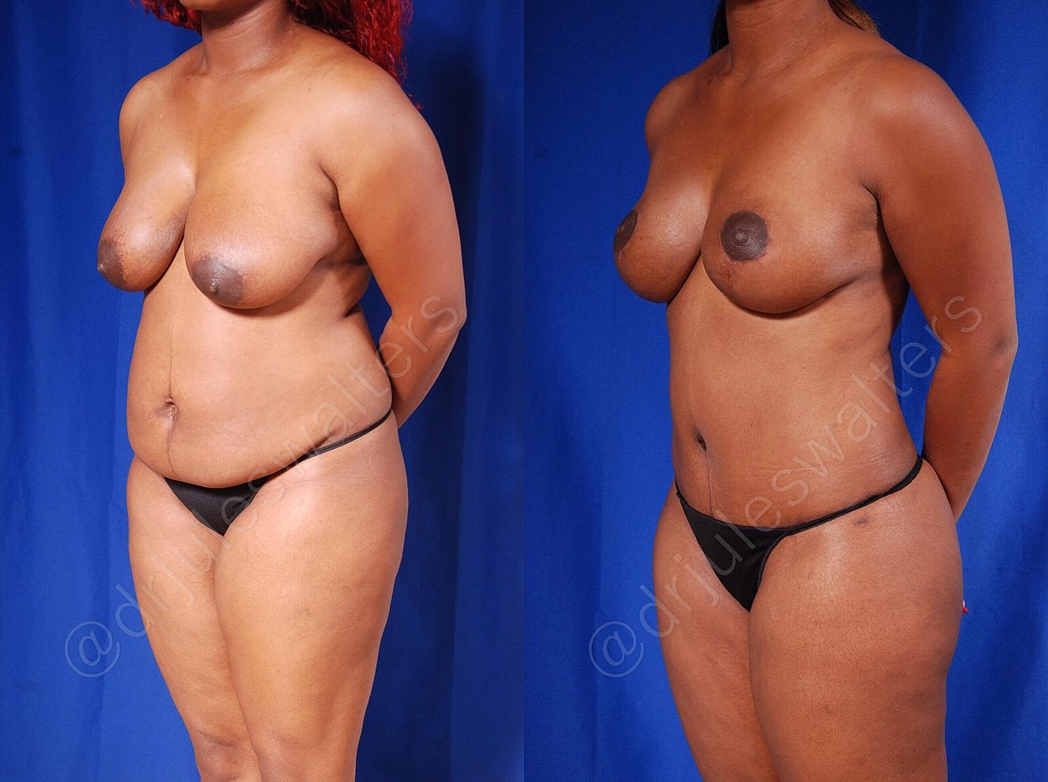 Tummy Tuck Before & After