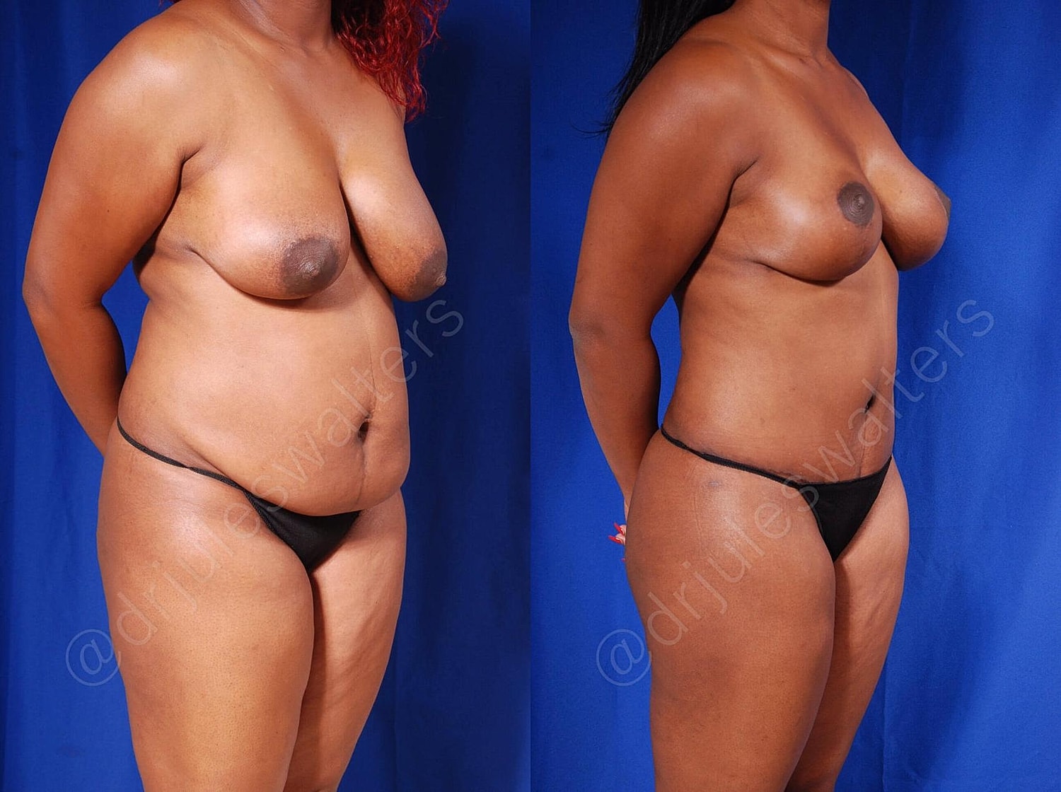 Tummy Tuck Before & After