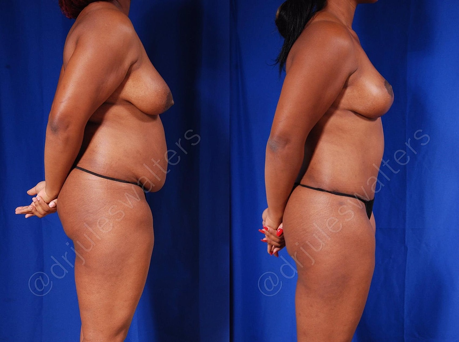 Tummy Tuck Before & After