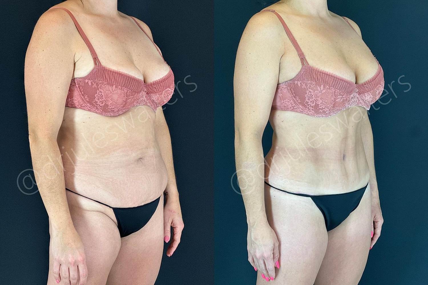 Tummy Tuck Before & After