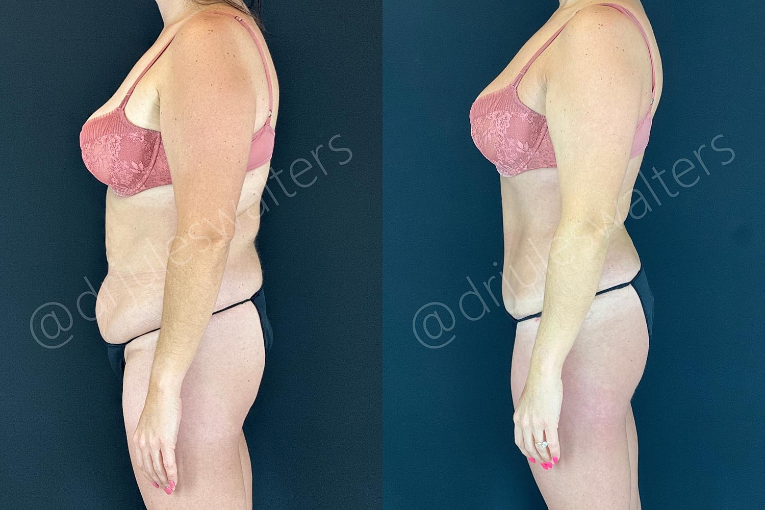 Tummy Tuck Before & After