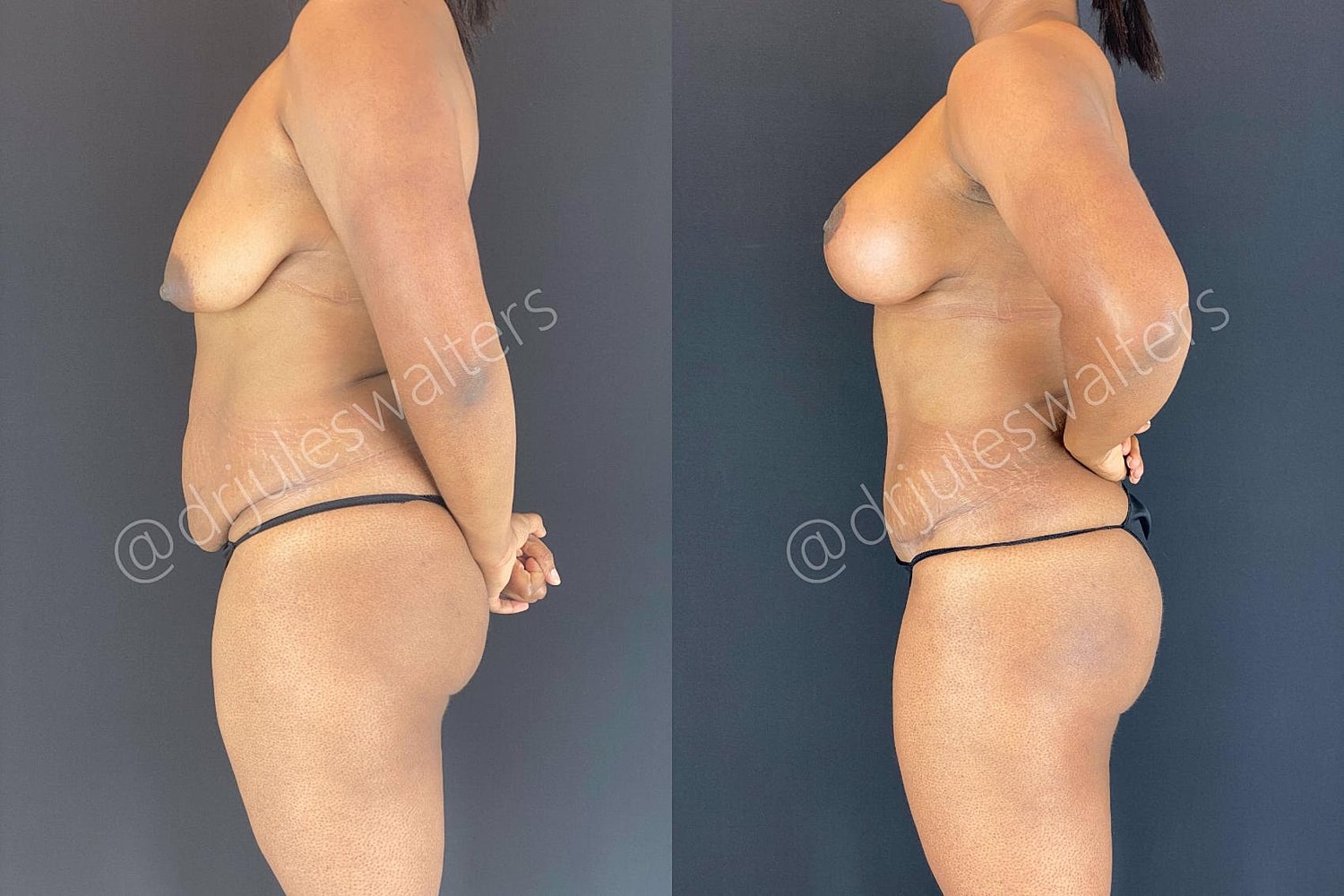 Tummy Tuck Before & After