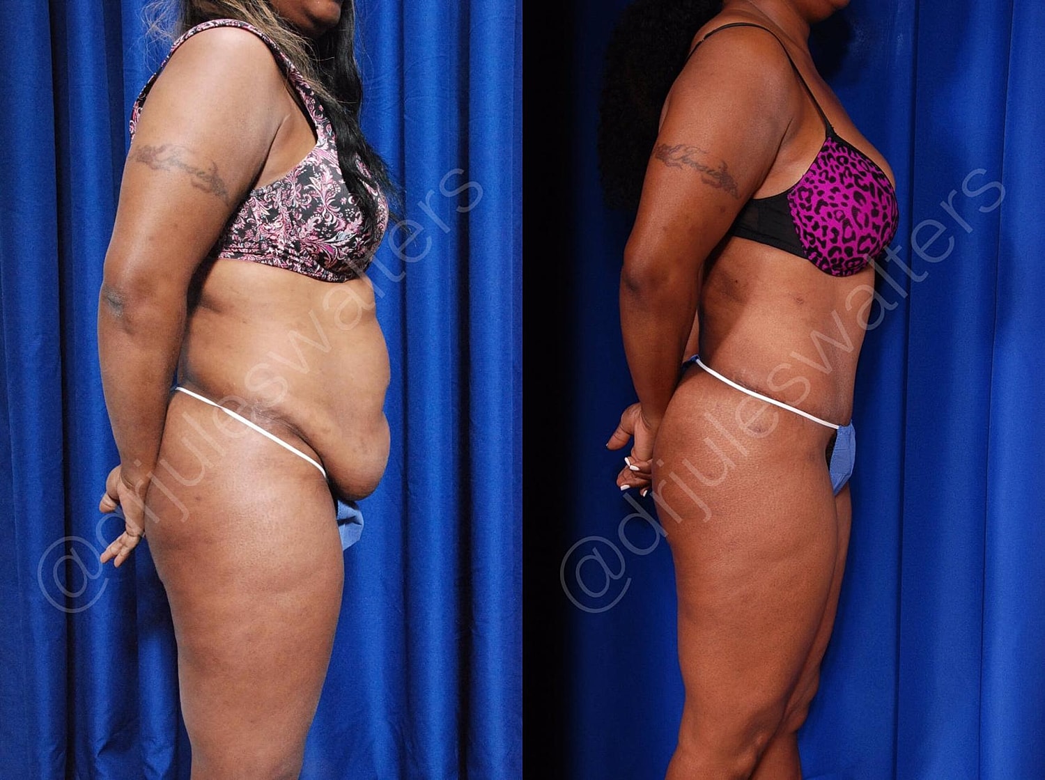 Tummy Tuck Before & After