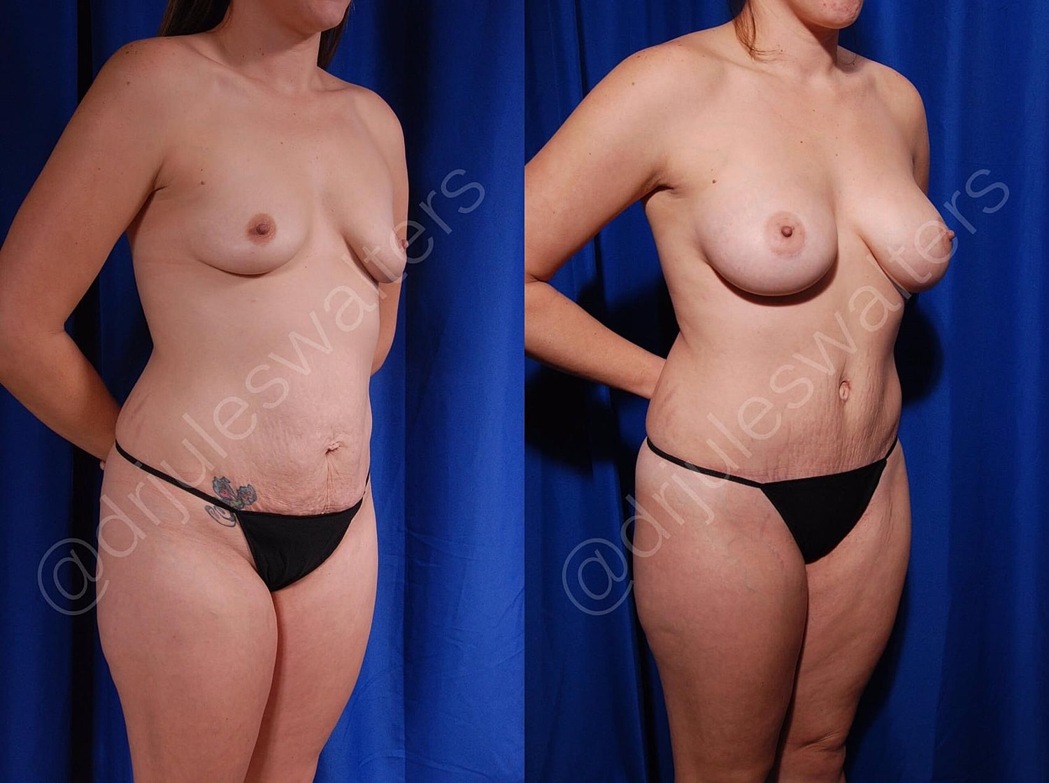 Tummy Tuck Before & After