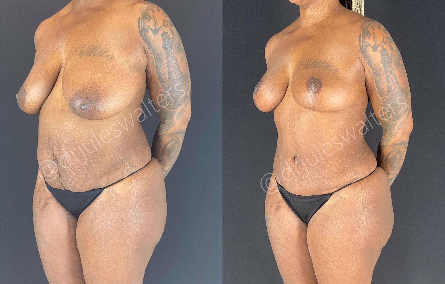 Tummy Tuck Before & After