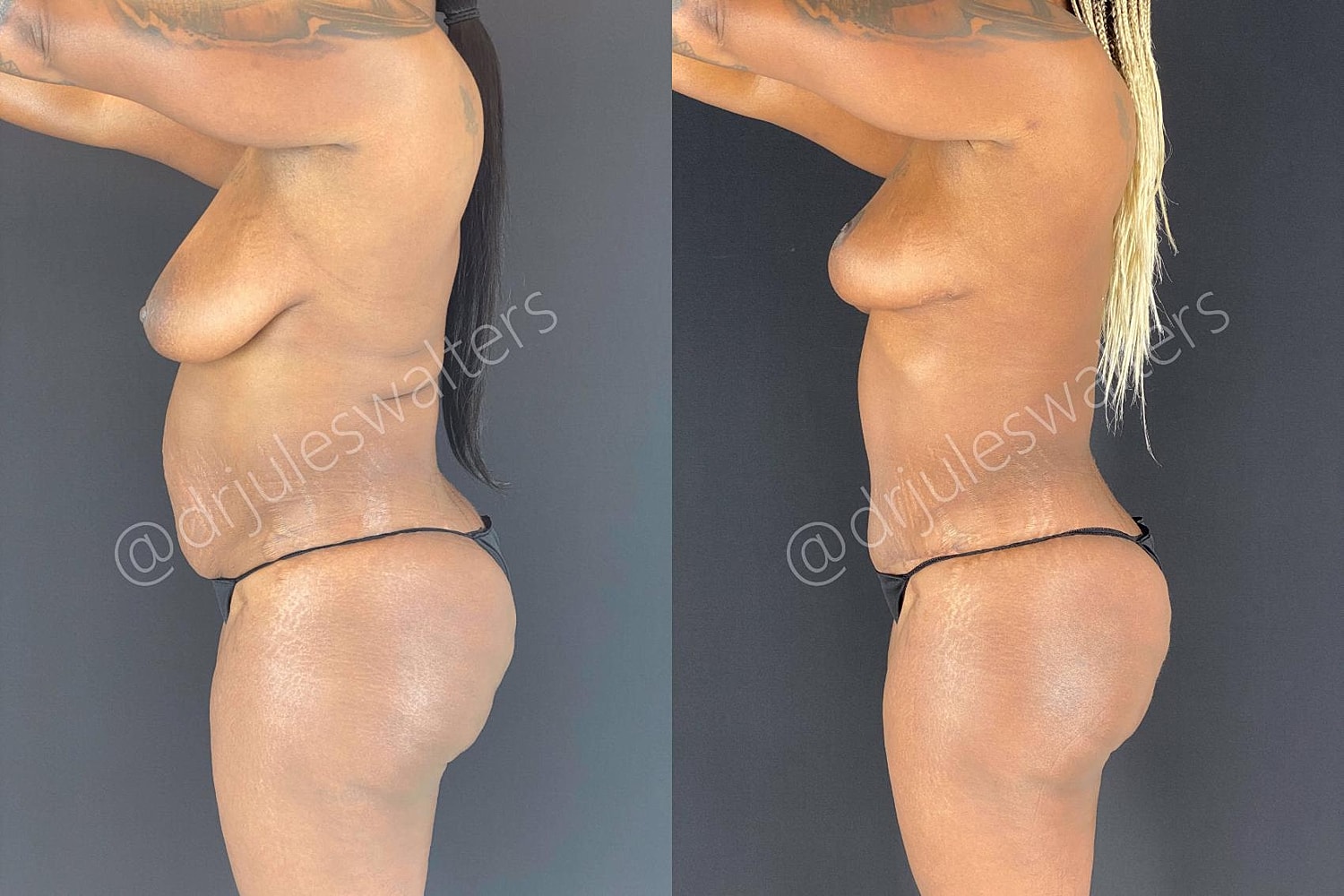 Tummy Tuck Before & After