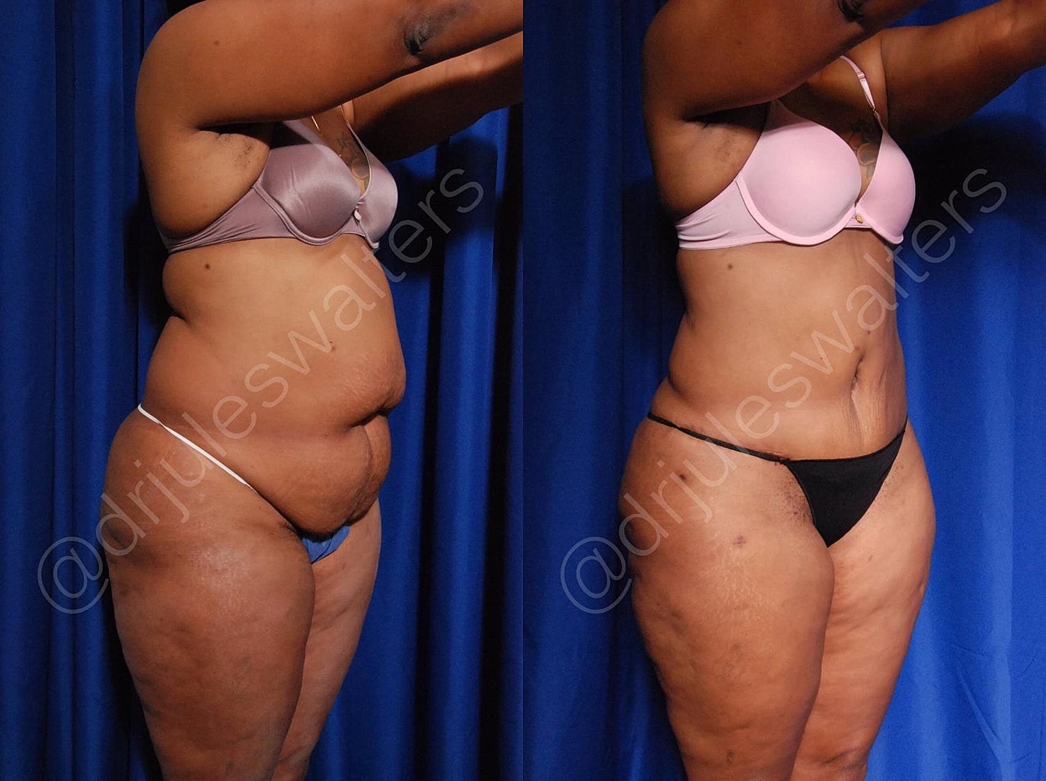 Tummy Tuck Before & After
