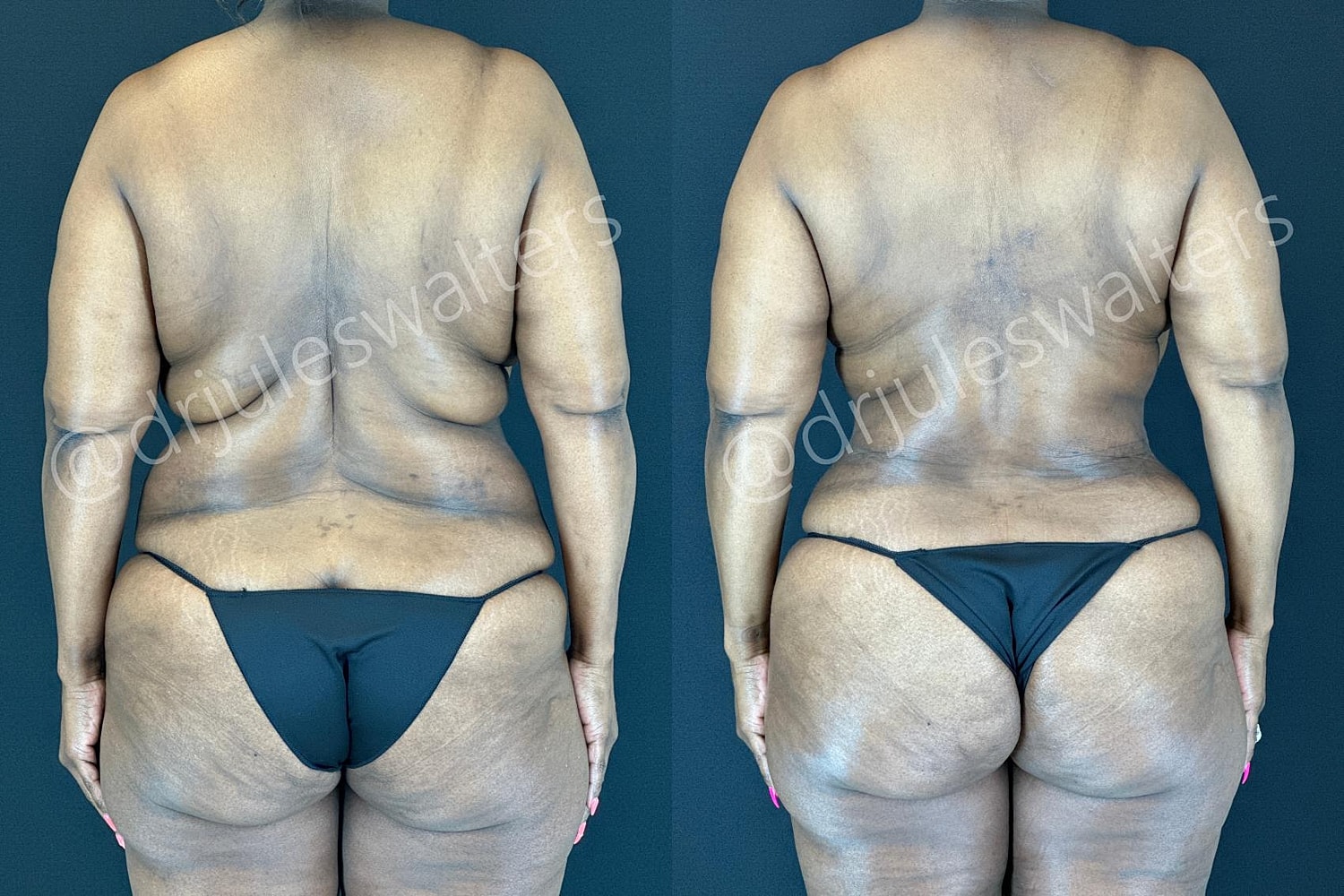 Tummy Tuck Before & After