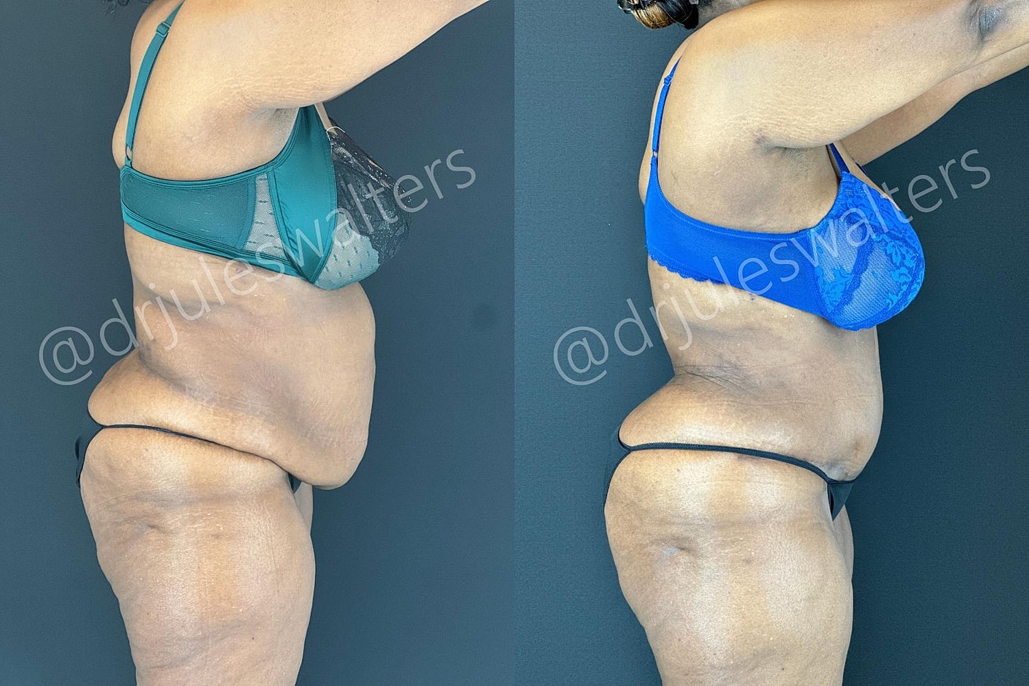 Tummy Tuck Before & After