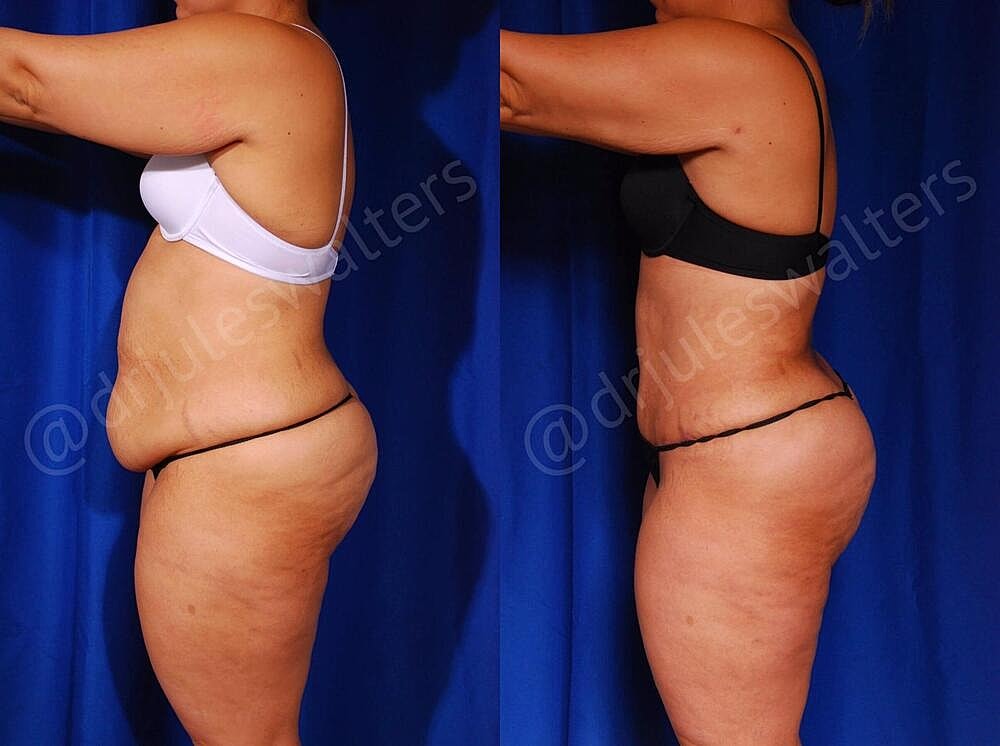 Tummy Tuck Before & After