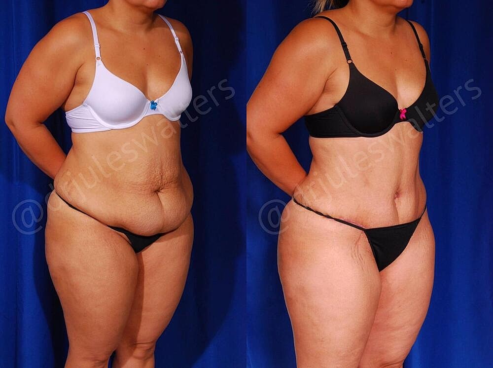 Tummy Tuck Before & After