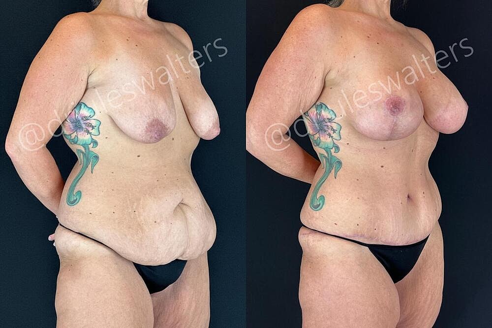 Tummy Tuck Before & After