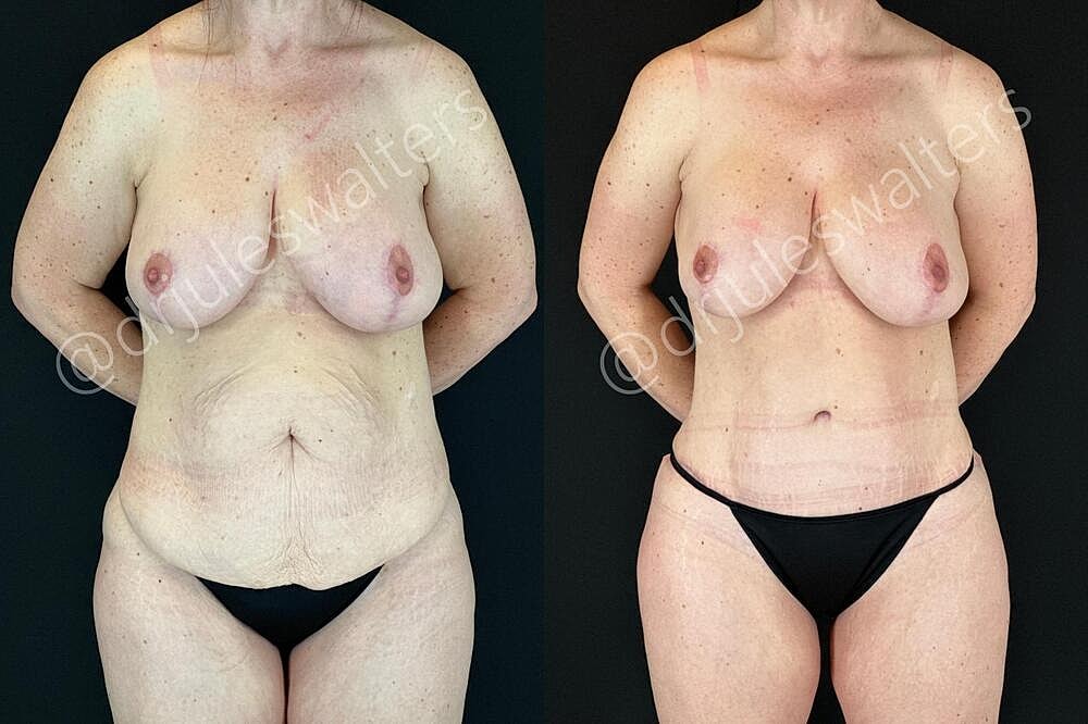 Tummy Tuck Before & After