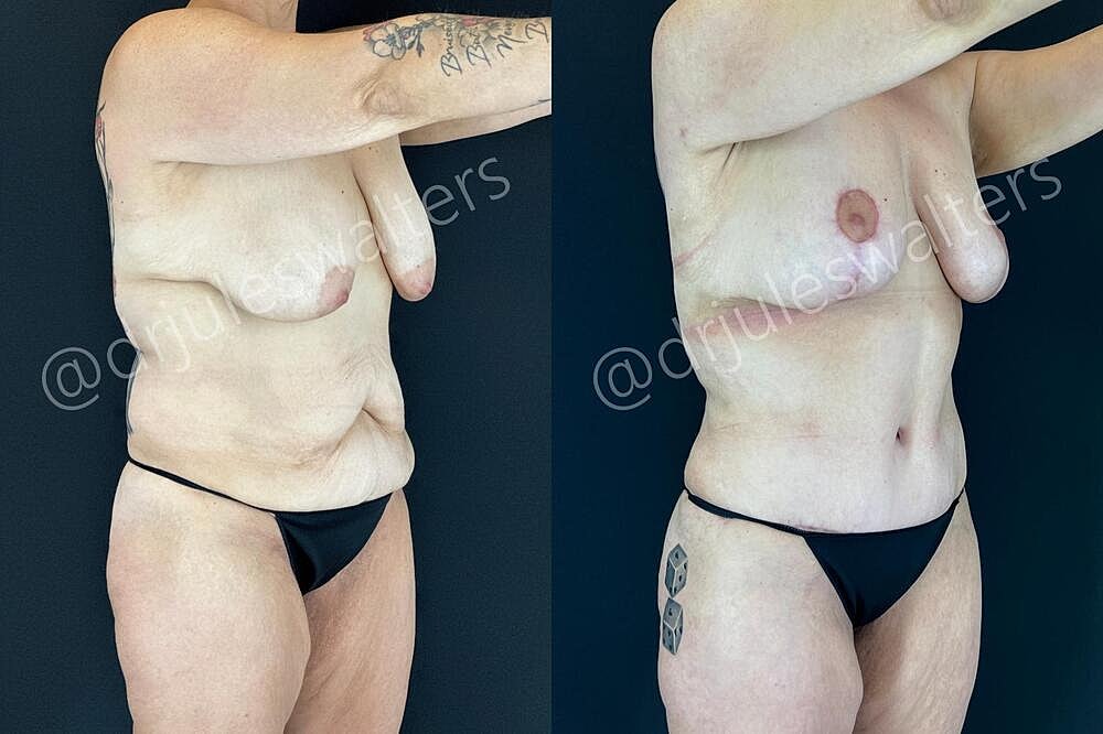 Tummy Tuck Before & After