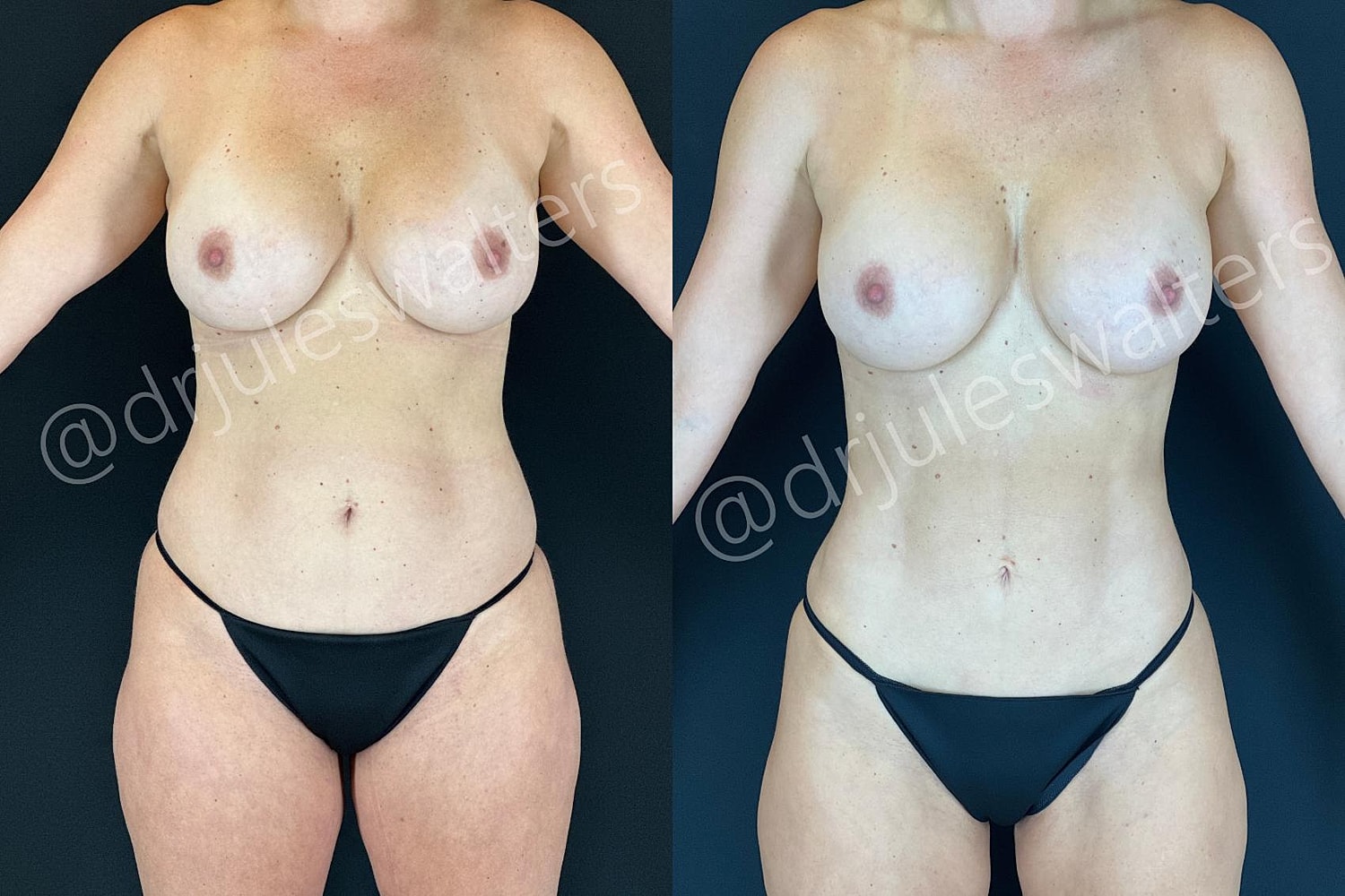Hidefinition Liposuction Before & After