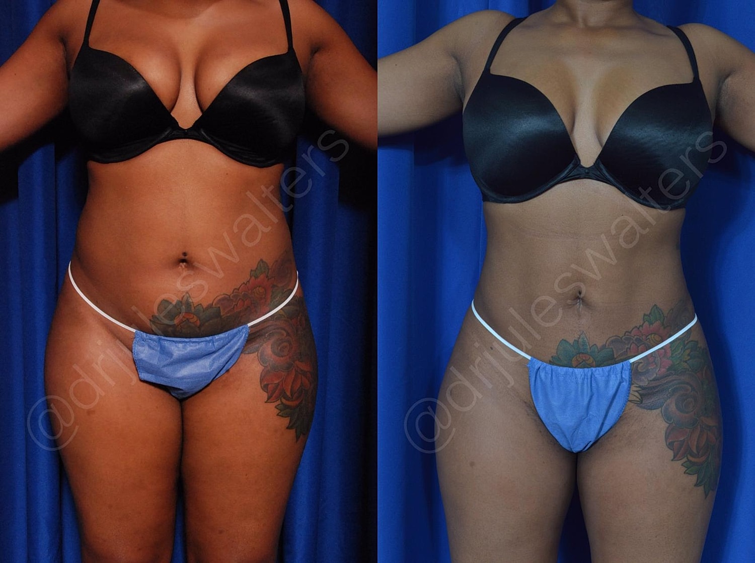 Hidefinition Liposuction Before & After