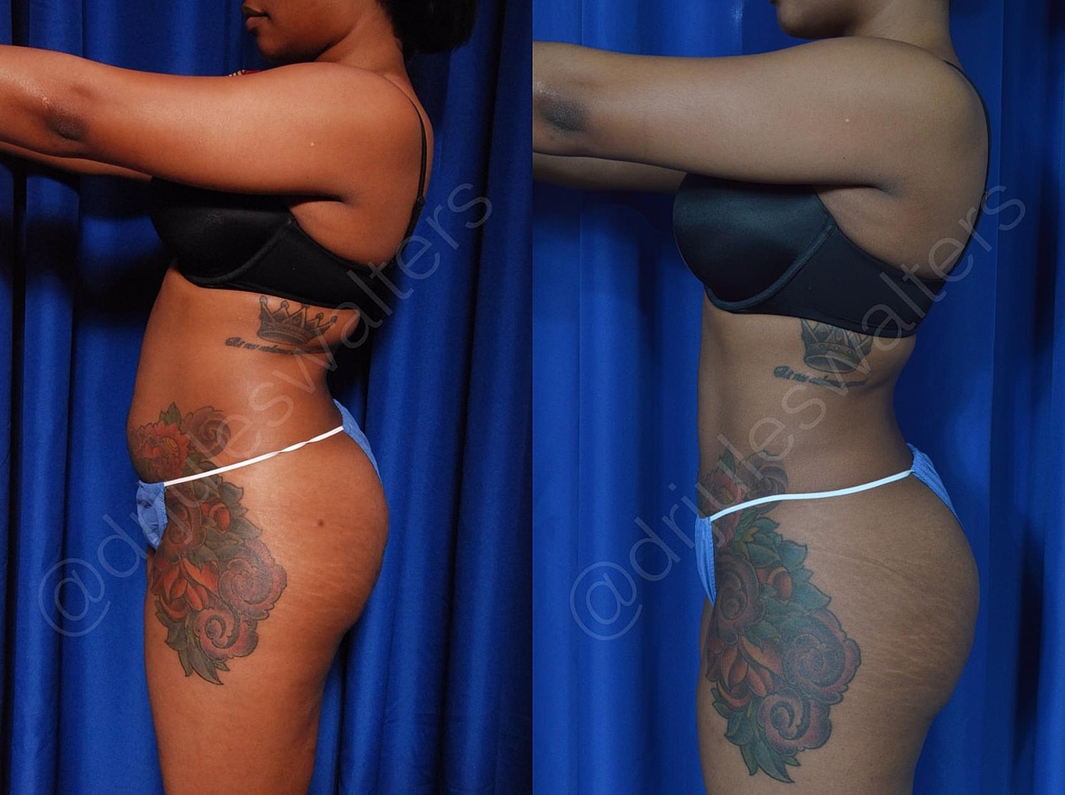 Hidefinition Liposuction Before & After