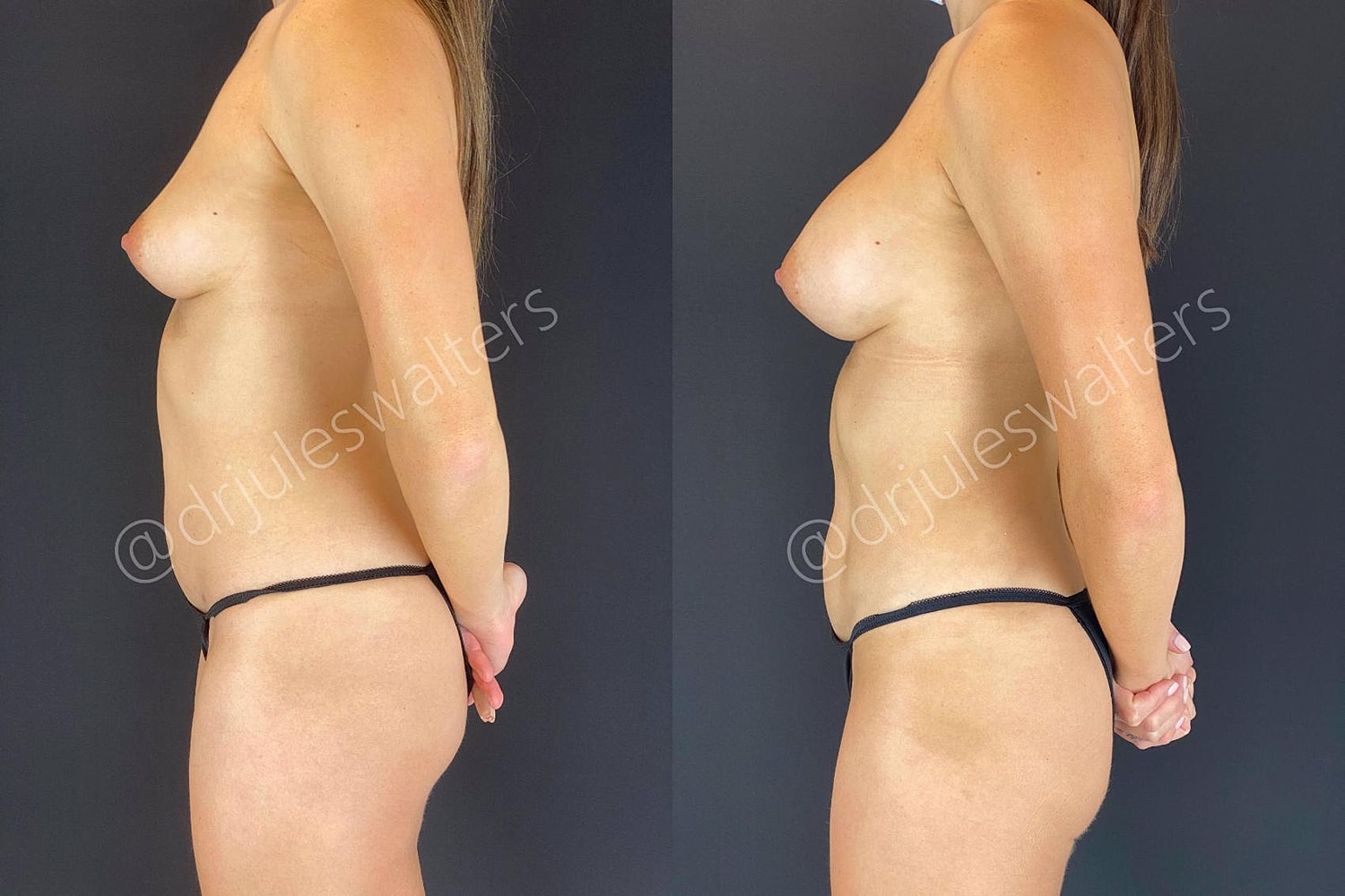 Hidefinition Liposuction Before & After