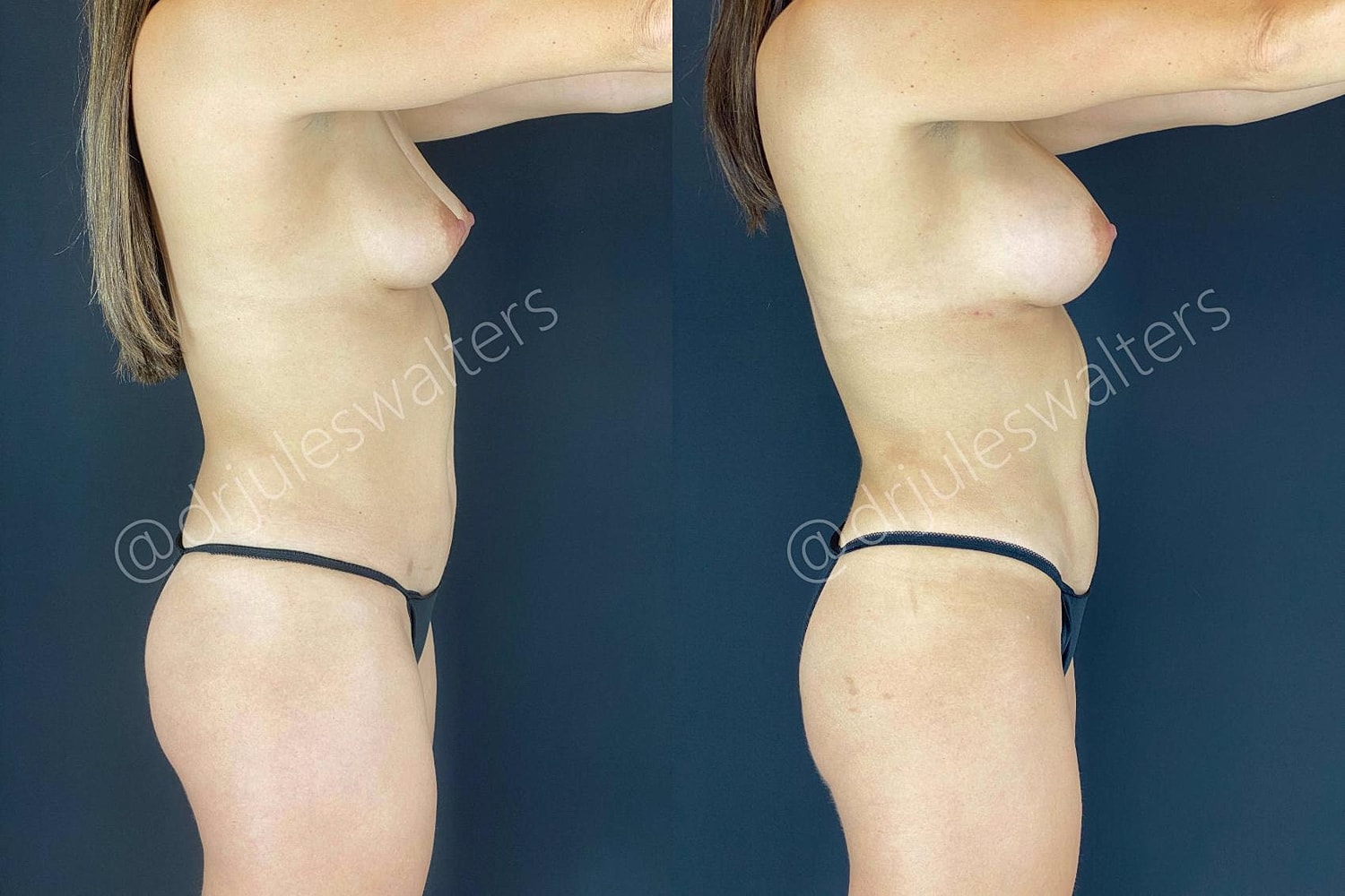 Hidefinition Liposuction Before & After